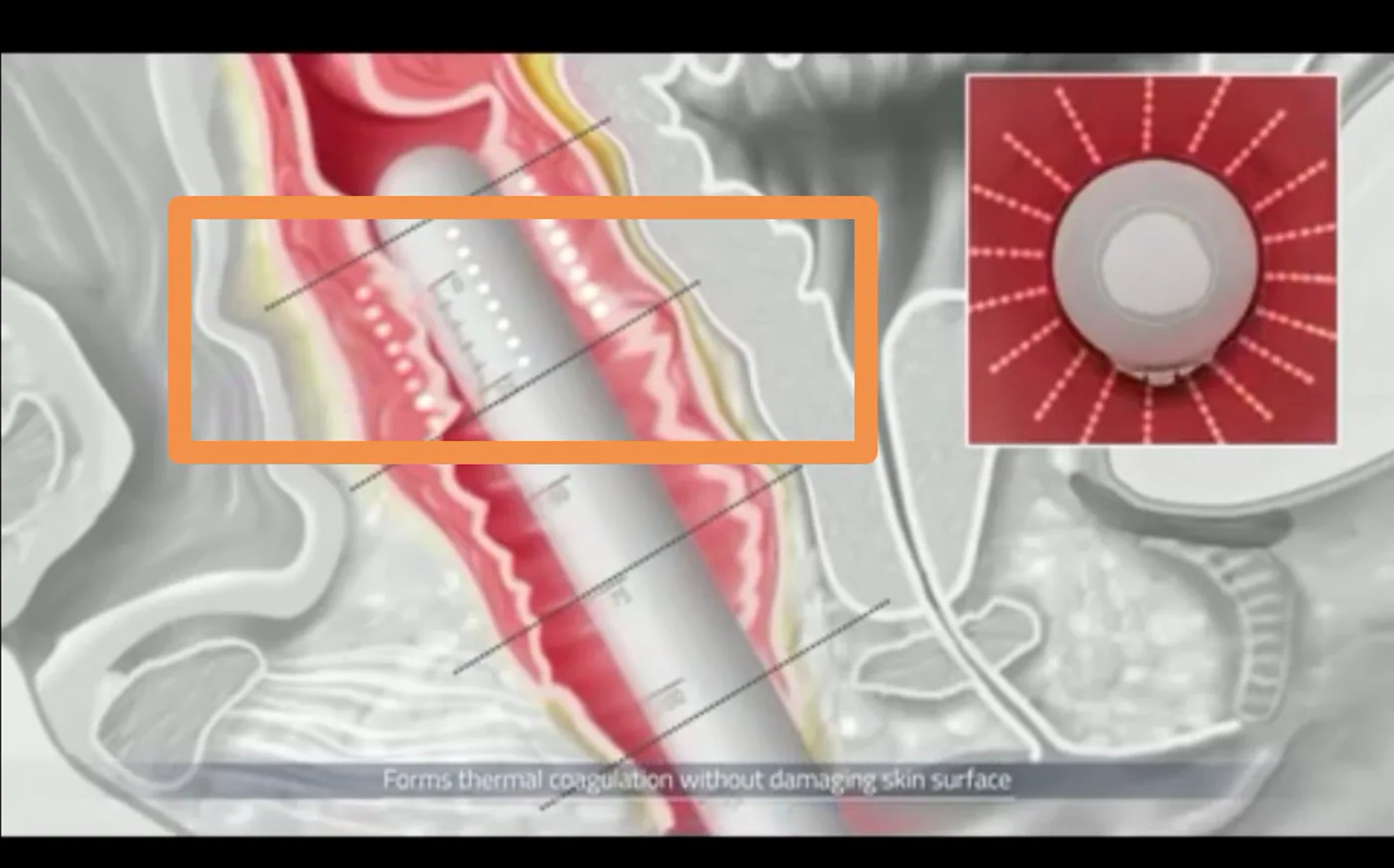 Diagrammatic HIFU vaginal rejuvenation treatment image